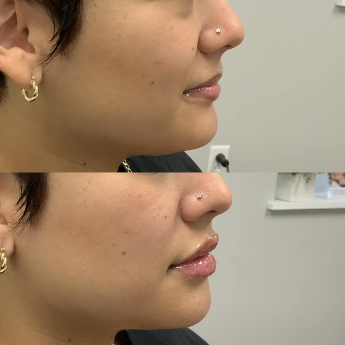 Lip Filler Before & After Gallery - Patient 401177 - Image 1