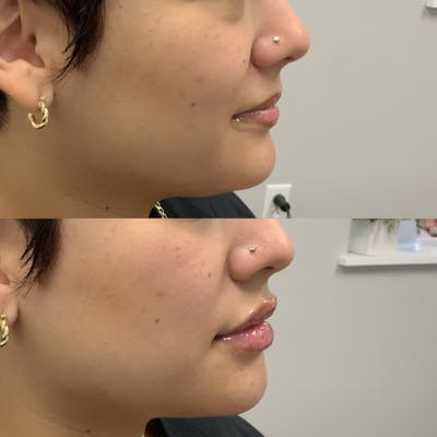 Lip Filler Before & After Gallery - Patient 401177 - Image 1