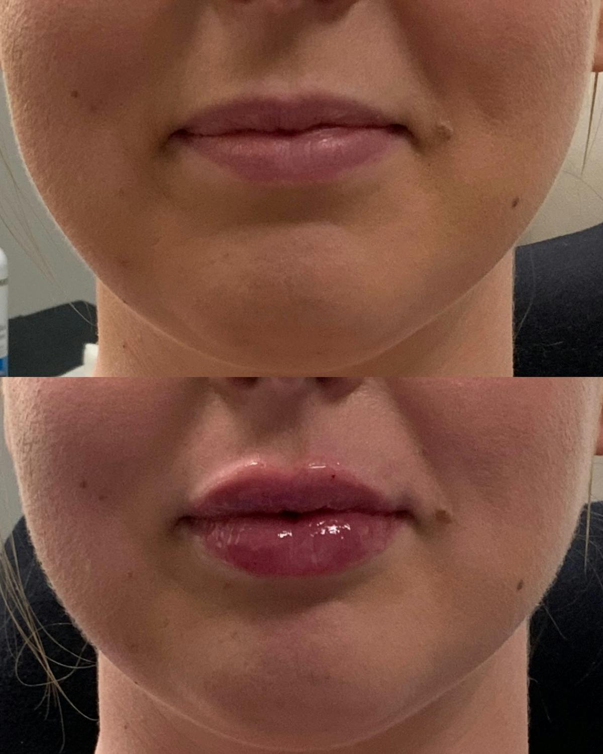 Lip Filler Before & After Gallery - Patient 368562 - Image 1