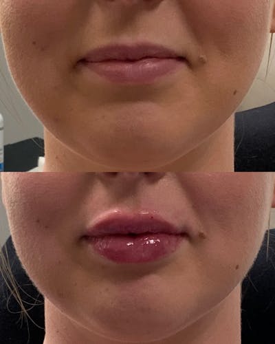 Lip Filler Before & After Gallery - Patient 368562 - Image 1