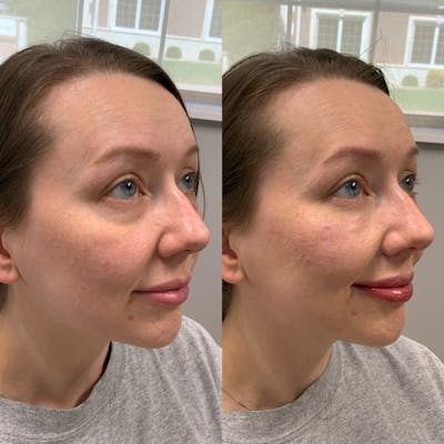 Dermal Filler Before & After Gallery - Patient 143936 - Image 2
