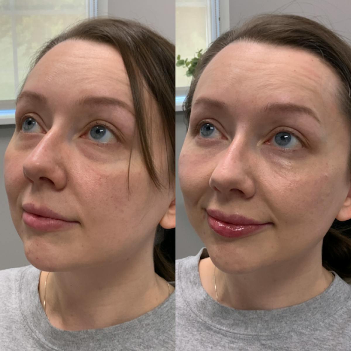 Lip Filler Before & After Gallery - Patient 359423 - Image 1