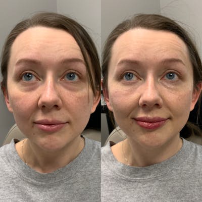 Facial Balancing Before & After Gallery - Patient 846249 - Image 1