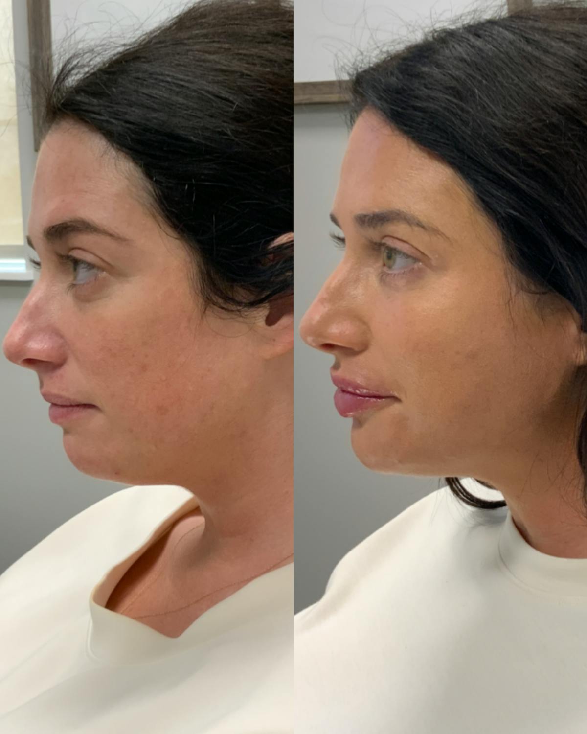 Dermal Filler Before & After Gallery - Patient 518590 - Image 2