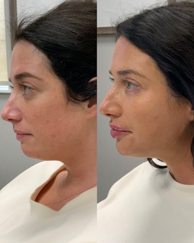 Facial Balancing Before & After Gallery - Patient 963697 - Image 2