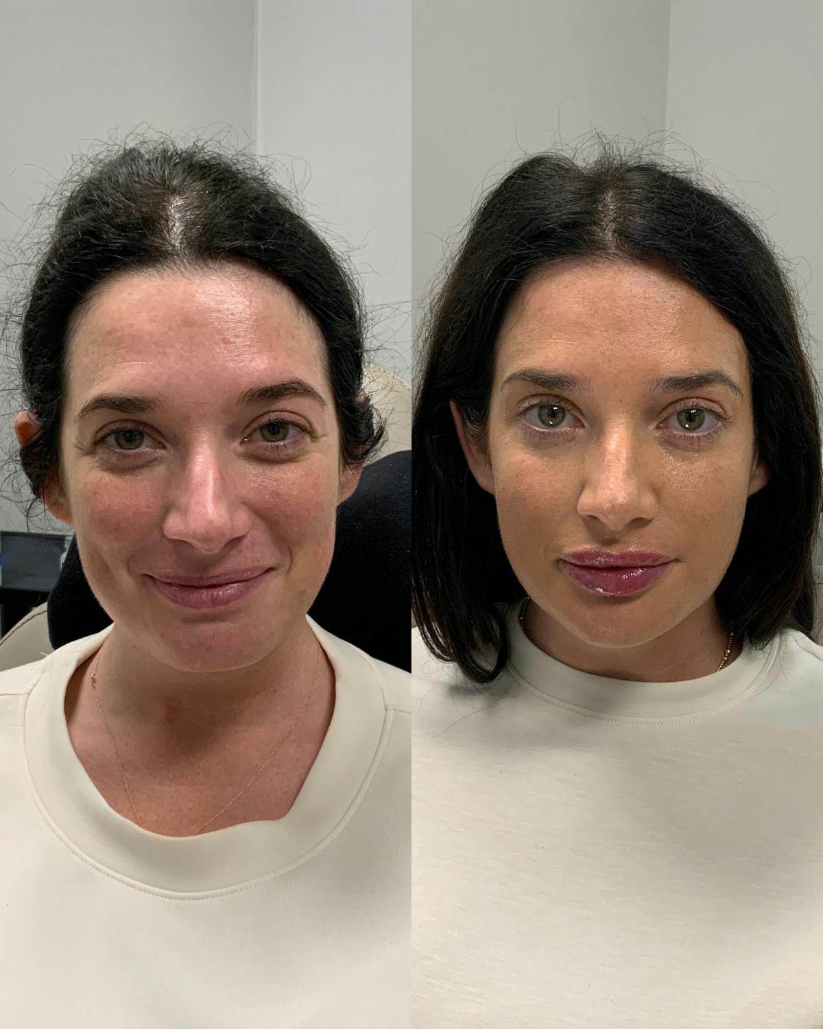 Dermal Filler Before & After Gallery - Patient 518590 - Image 1