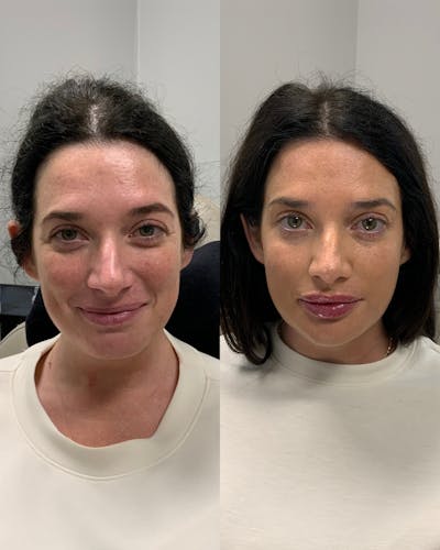 Facial Balancing Before & After Gallery - Patient 963697 - Image 1