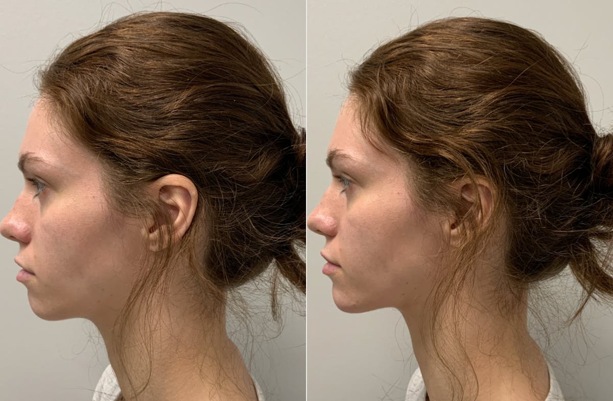 Dermal Filler Before & After Gallery - Patient 236666 - Image 2