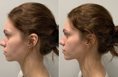 Dermal Filler Before & After Gallery - Patient 236666 - Image 2