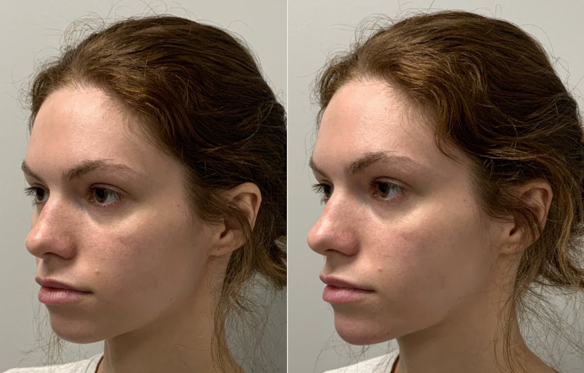 Dermal Filler Before & After Gallery - Patient 236666 - Image 1