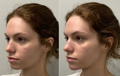 Dermal Filler Before & After Gallery - Patient 236666 - Image 1