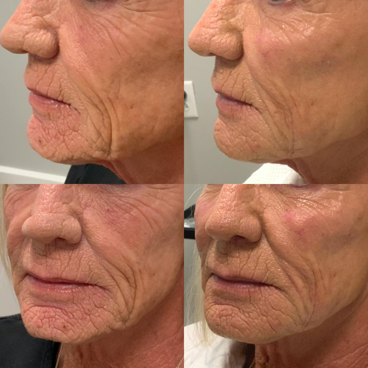 Dermal Filler Before & After Gallery - Patient 327138 - Image 1
