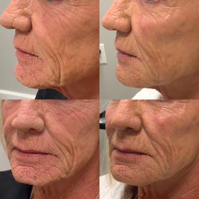 Dermal Filler Before & After Gallery - Patient 327138 - Image 1
