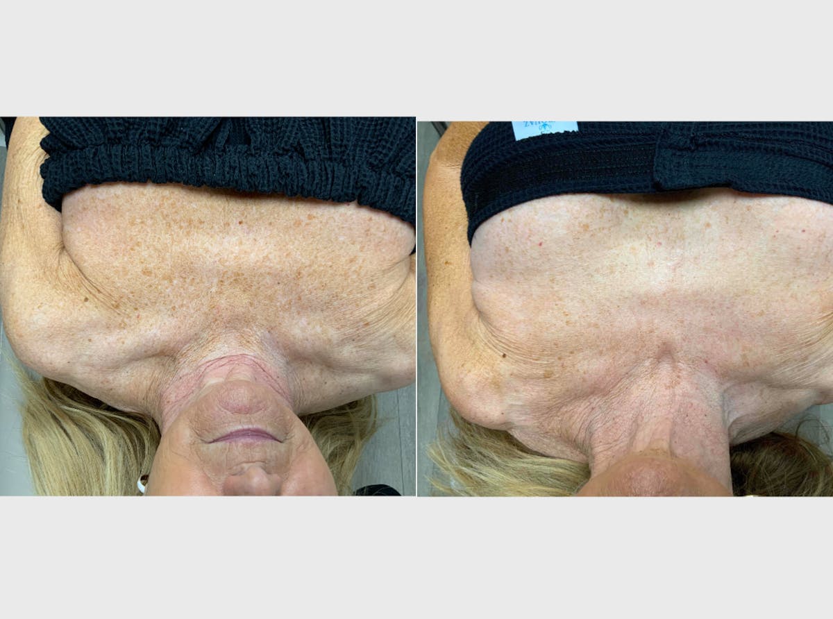IPL Before & After Gallery - Patient 204706 - Image 1