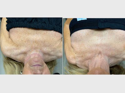 IPL Before & After Gallery - Patient 204706 - Image 1