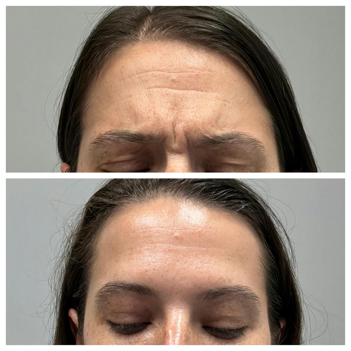 BOTOX Before & After Gallery - Patient 336009 - Image 3