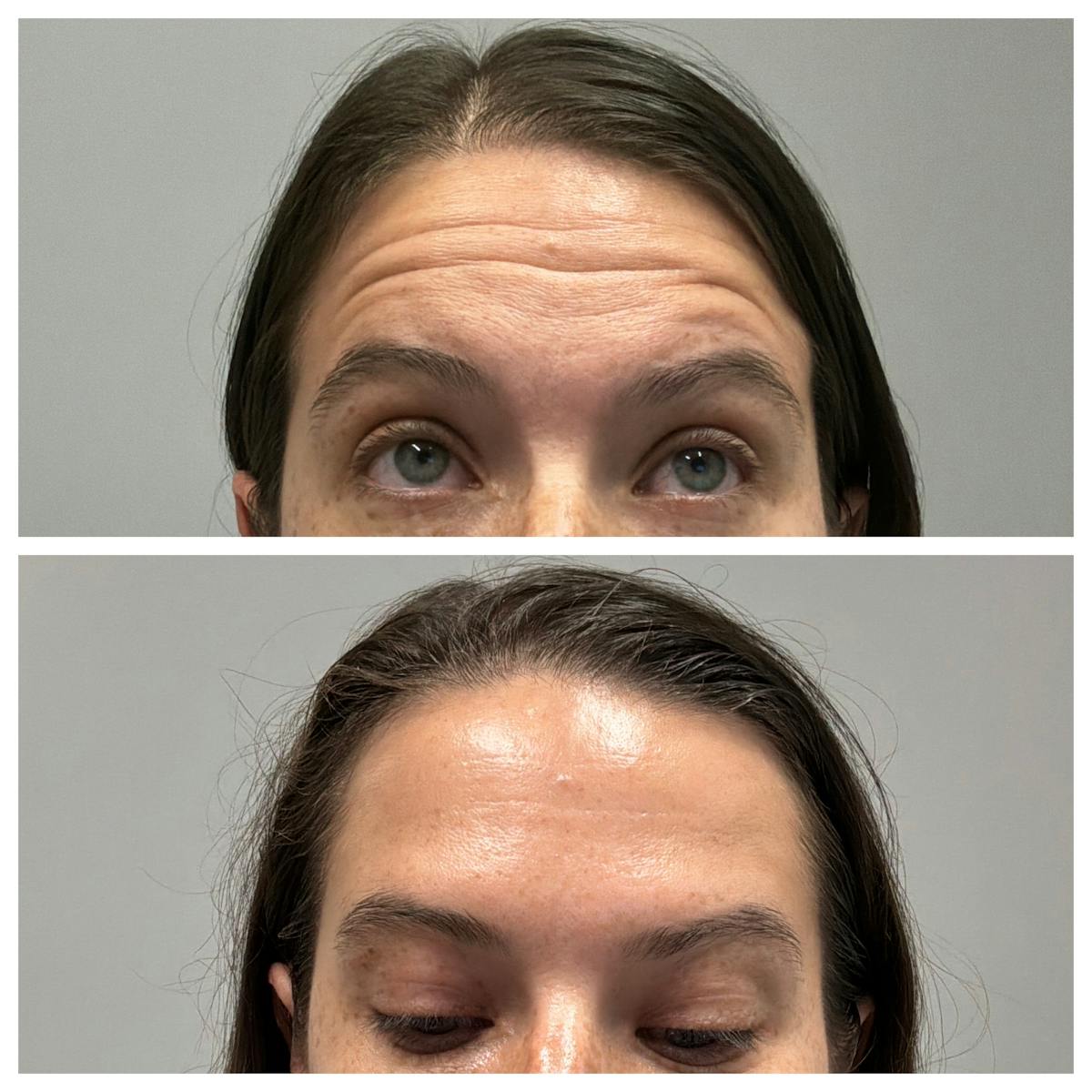 BOTOX Before & After Gallery - Patient 336009 - Image 2