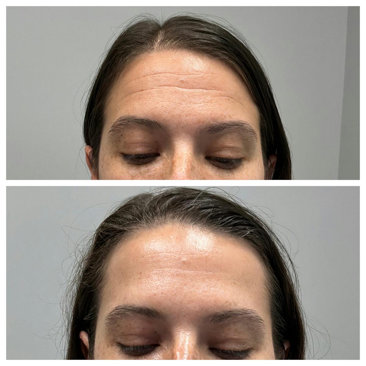 BOTOX Before & After Gallery - Patient 336009 - Image 1