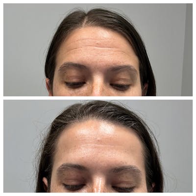 BOTOX Before & After Gallery - Patient 336009 - Image 1