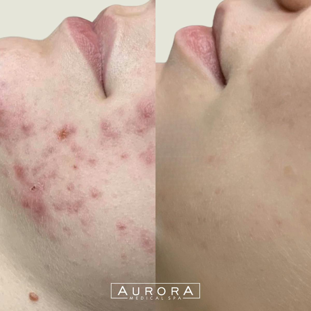 LaseMD Before & After Gallery - Patient 247030 - Image 1