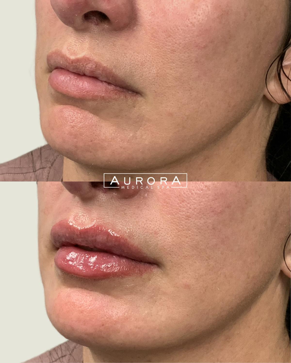 Lip Filler Before & After Gallery - Patient 217892 - Image 1