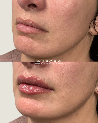 Lip Filler Before & After Gallery - Patient 217892 - Image 1