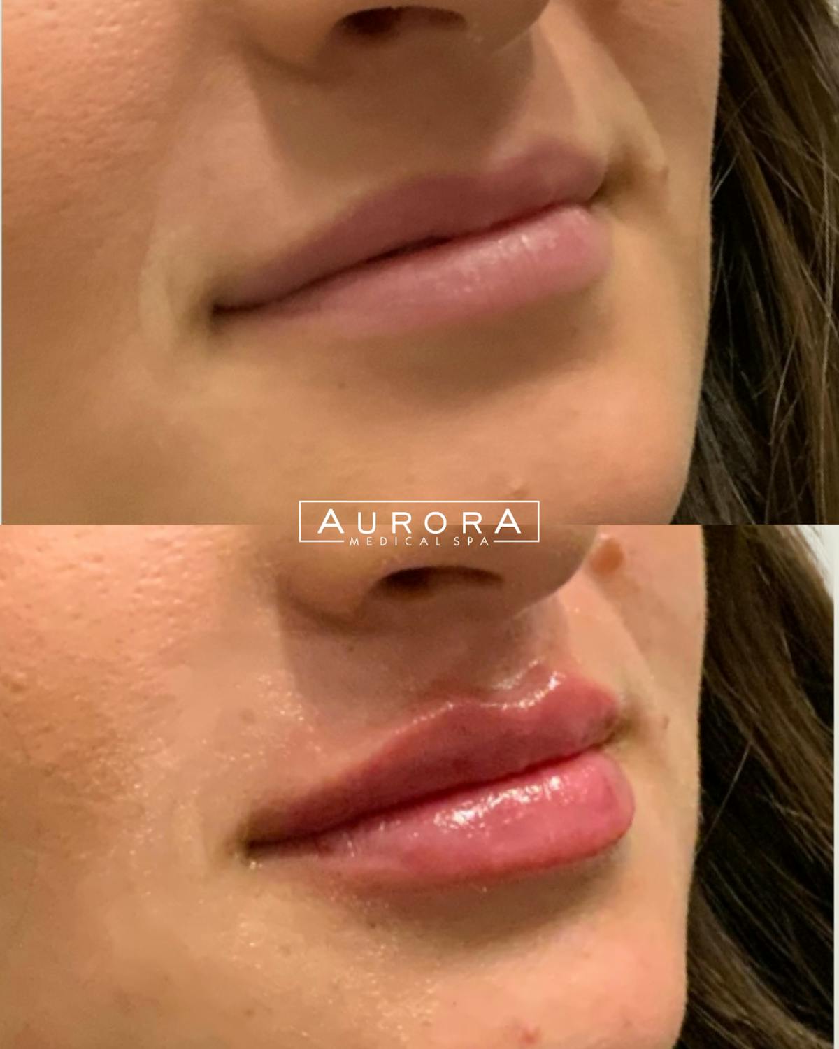Lip Filler Before & After Gallery - Patient 362232 - Image 1