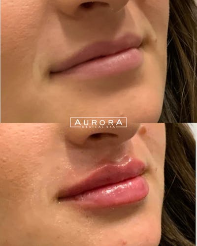 Lip Filler Before & After Gallery - Patient 362232 - Image 1