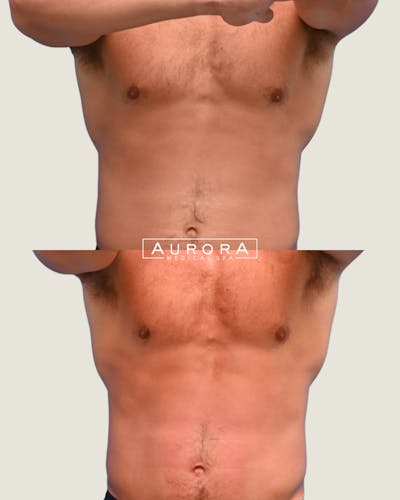 Coolsculpting Elite Before & After Gallery - Patient 420994 - Image 1