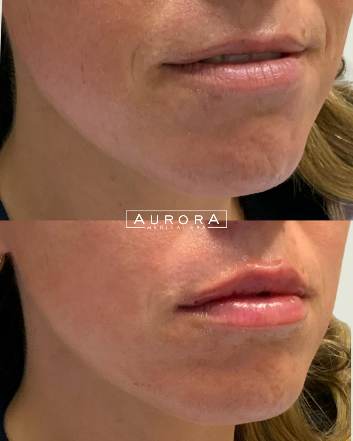 Lip Filler Before & After Gallery - Patient 402816 - Image 1