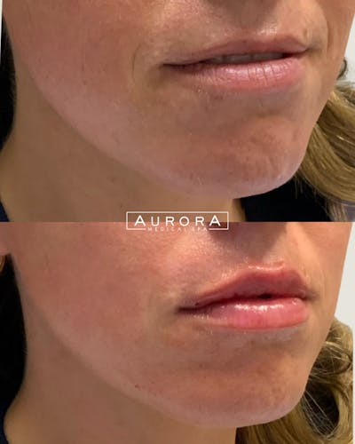 Lip Filler Before & After Gallery - Patient 402816 - Image 1