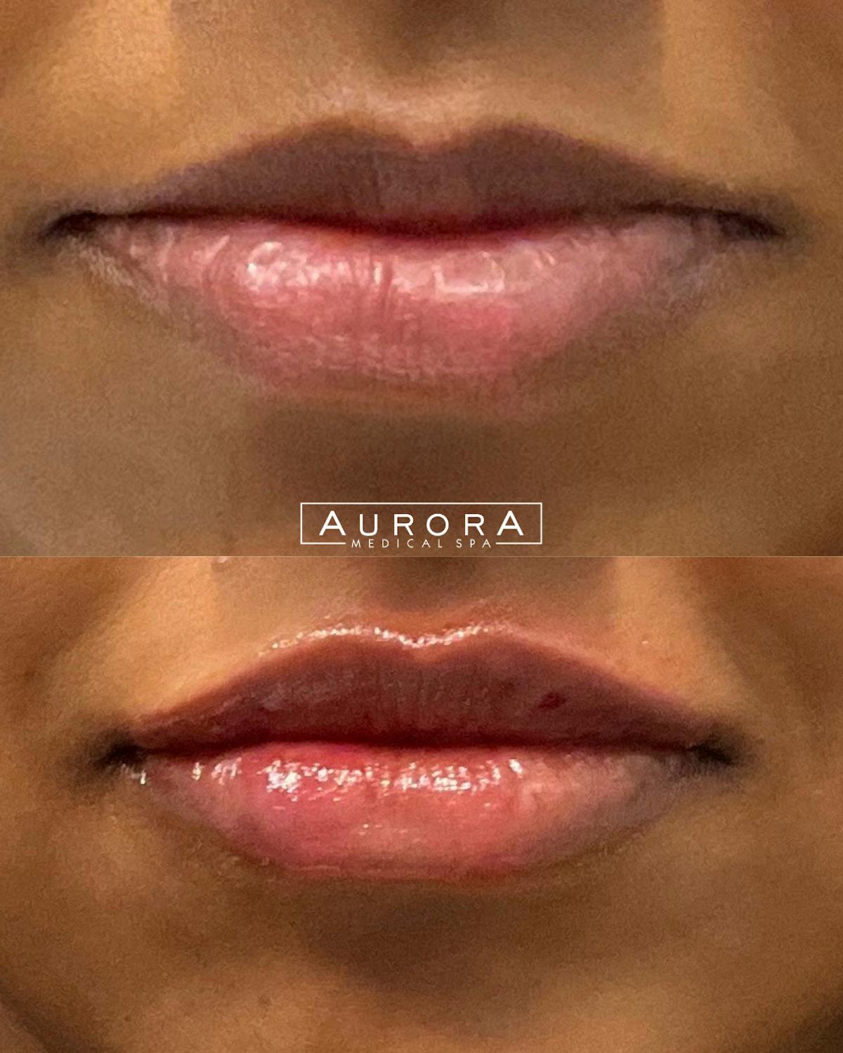Lip Filler Before & After Gallery - Patient 139778 - Image 1