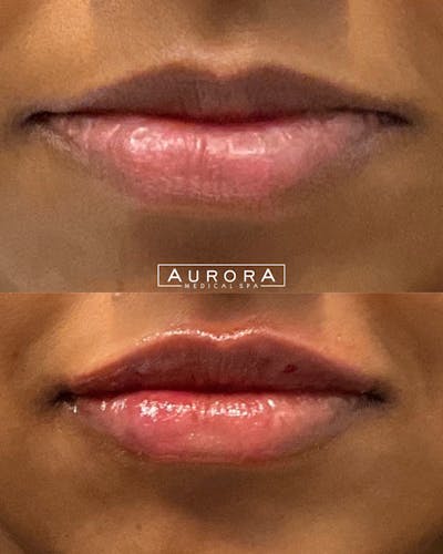 Lip Filler Before & After Gallery - Patient 139778 - Image 1