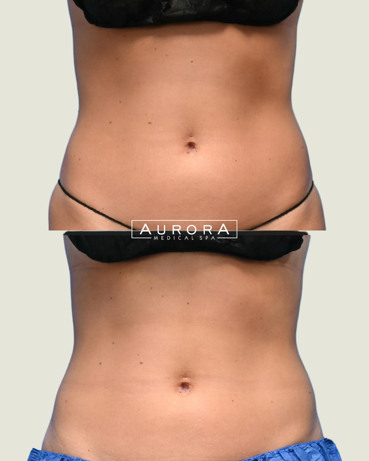 Coolsculpting Elite Before & After Gallery - Patient 208557 - Image 2