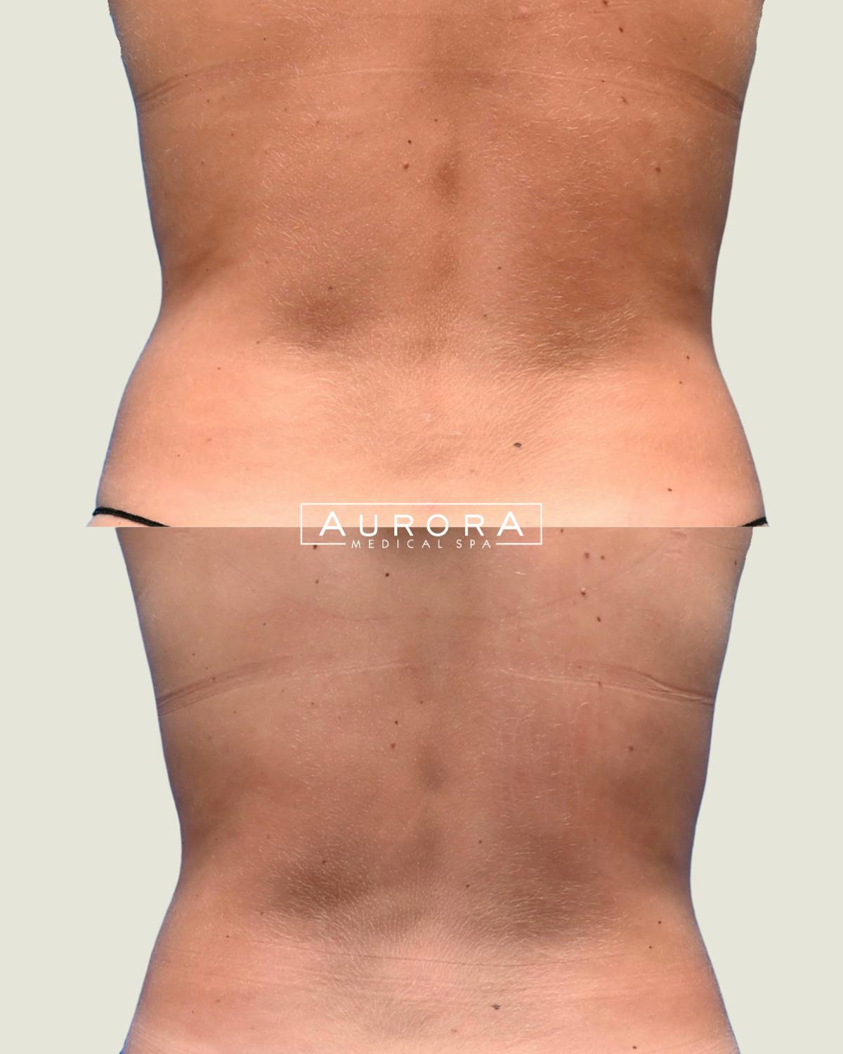 Coolsculpting Elite Before & After Gallery - Patient 208557 - Image 1