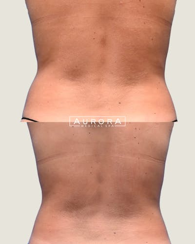 Coolsculpting Elite Before & After Gallery - Patient 208557 - Image 1