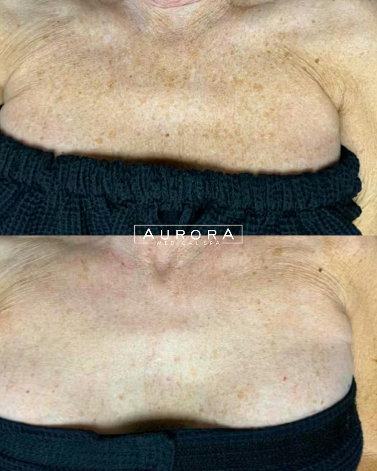 IPL Before & After Gallery - Patient 141392 - Image 1