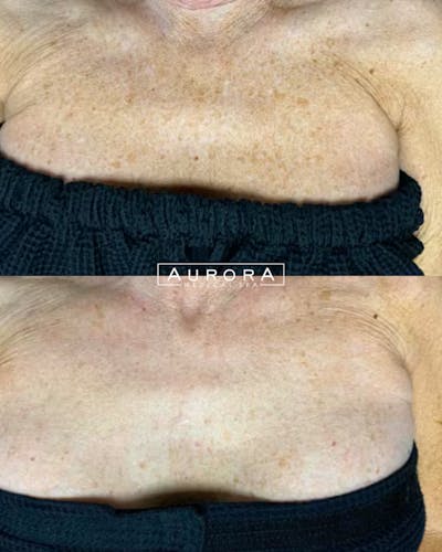 IPL Before & After Gallery - Patient 141392 - Image 1