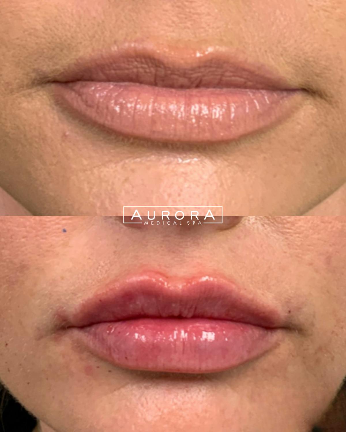 Lip Filler Before & After Gallery - Patient 197109 - Image 1