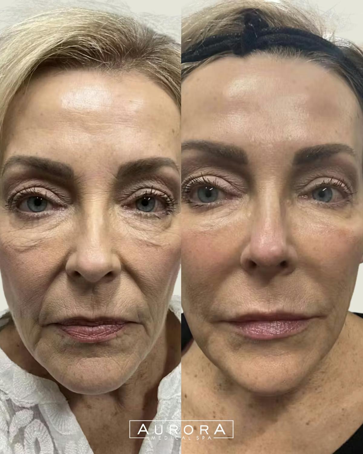 Skin Vive Before & After Gallery - Patient 358917 - Image 1