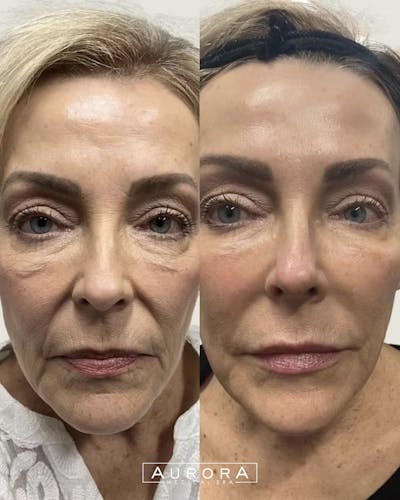 Skin Vive Before & After Gallery - Patient 358917 - Image 1