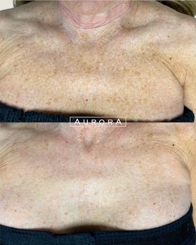 IPL Before & After Gallery - Patient 104328 - Image 1