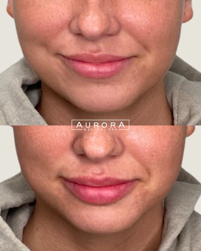 Lip Filler Before & After Gallery - Patient 428831 - Image 1