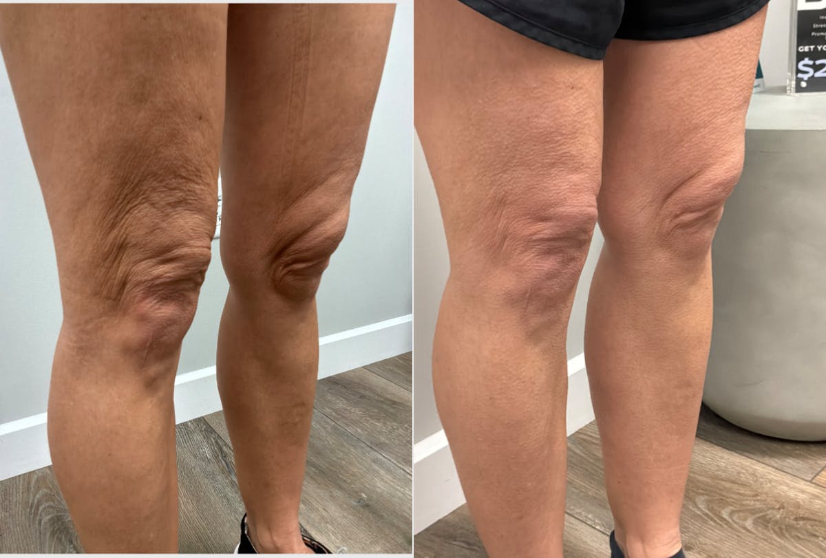 Total Skin Solutions Before & After Gallery - Patient 340765 - Image 2