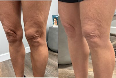 Total Skin Solutions Before & After Gallery - Patient 340765 - Image 1