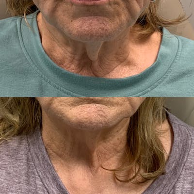 Total Skin Solutions Before & After Gallery - Patient 120997 - Image 1