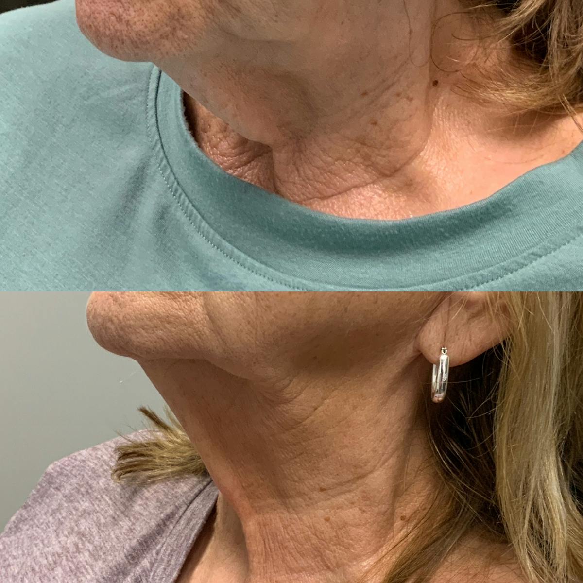Total Skin Solutions Before & After Gallery - Patient 120997 - Image 2