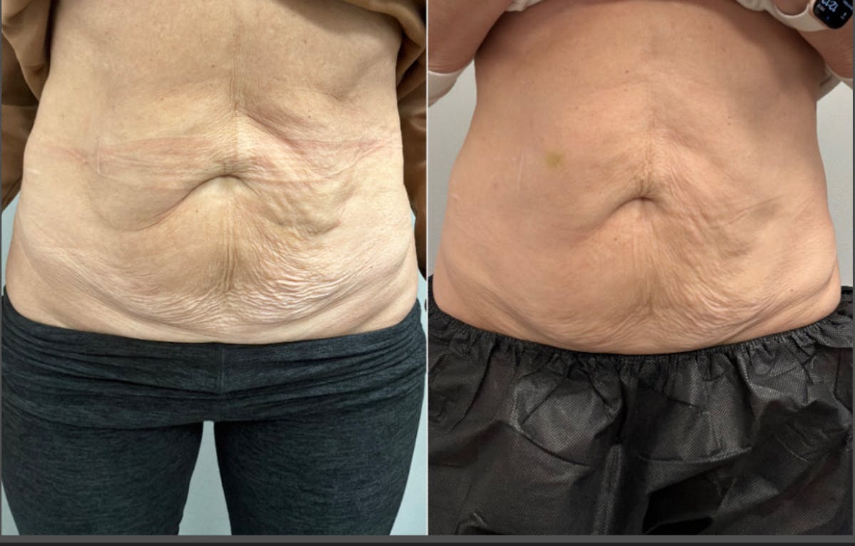 Total Skin Solutions Before & After Gallery - Patient 249937 - Image 1