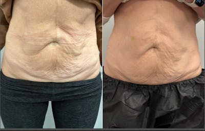 Total Skin Solutions Before & After Gallery - Patient 249937 - Image 1