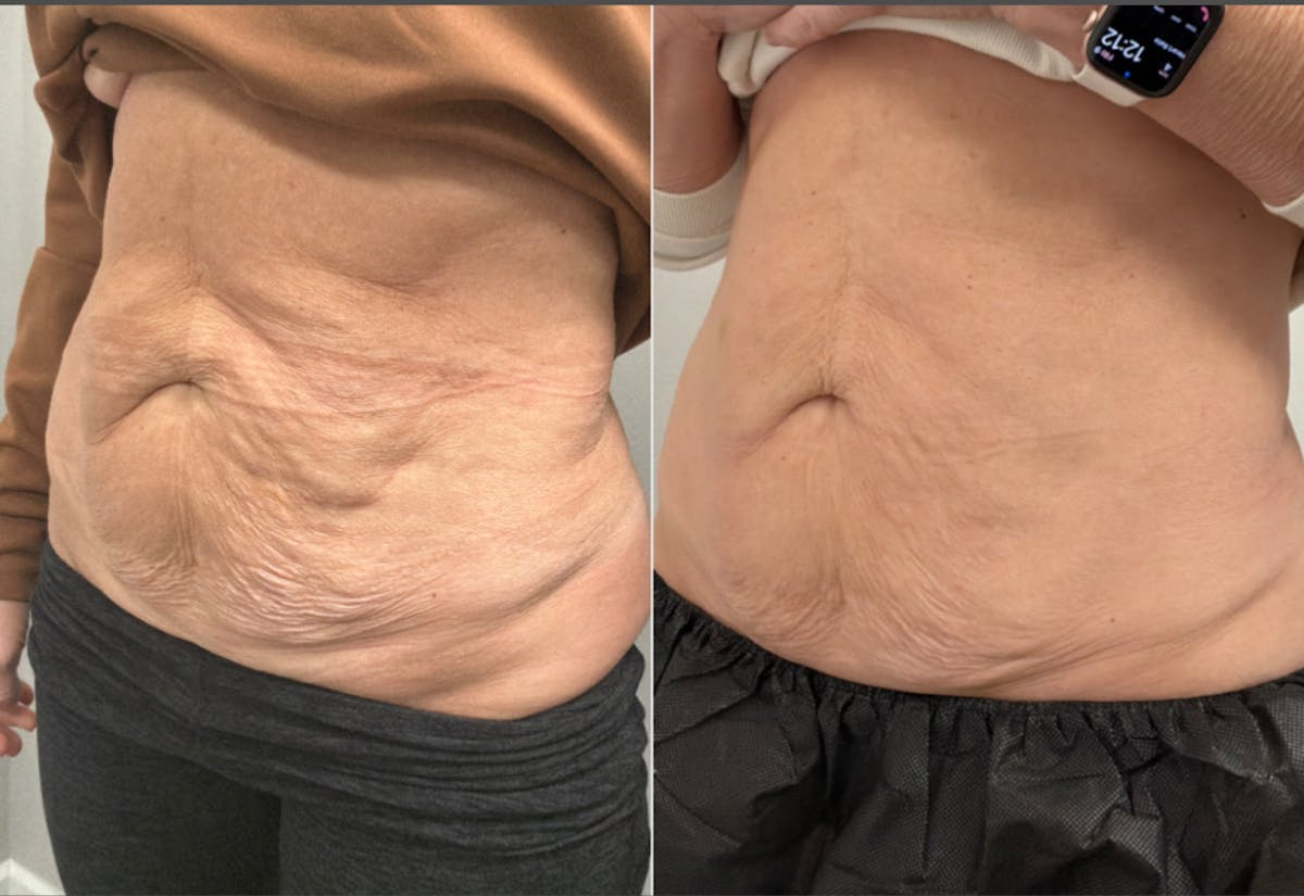 Total Skin Solutions Before & After Gallery - Patient 249937 - Image 2